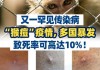 突然暴涨110%！猴痘疫情，来势汹汹！