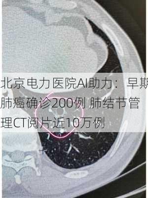 北京电力医院AI助力：早期肺癌确诊200例 肺结节管理CT阅片近10万例