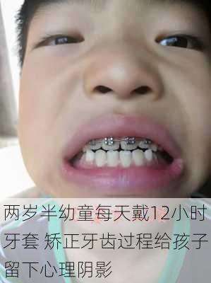 两岁半幼童每天戴12小时牙套 矫正牙齿过程给孩子留下心理阴影