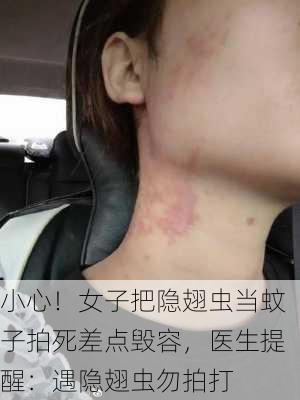 小心！女子把隐翅虫当蚊子拍死差点毁容，医生提醒：遇隐翅虫勿拍打